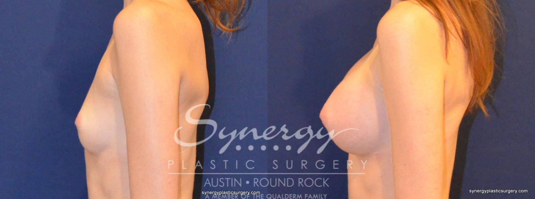 Before & After Breast Augmentation Case 260 View #1 View in Austin, TX