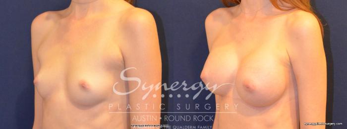 Before & After Breast Augmentation Case 260 View #2 View in Austin, TX