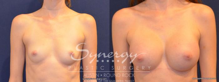 Before & After Breast Augmentation Case 260 View #3 View in Austin, TX