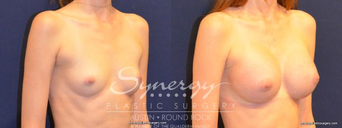 Before & After Breast Augmentation Case 260 View #4 View in Austin, TX