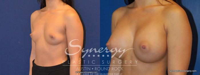 Before & After Breast Augmentation Case 263 View #1 View in Austin, TX
