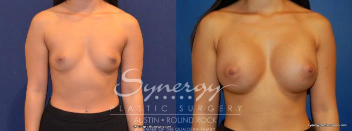 Before & After Breast Augmentation Case 263 View #2 View in Austin, TX