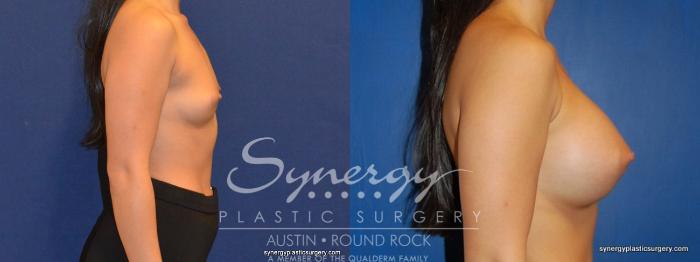 Before & After Breast Augmentation Case 263 View #3 View in Austin, TX