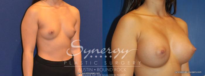 Before & After Breast Augmentation Case 263 View #4 View in Austin, TX
