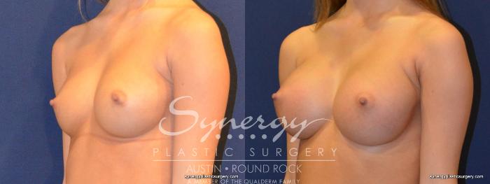 Before & After Breast Augmentation Case 264 View #2 View in Austin, TX