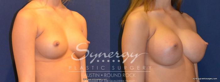 Before & After Breast Augmentation Case 264 View #3 View in Austin, TX