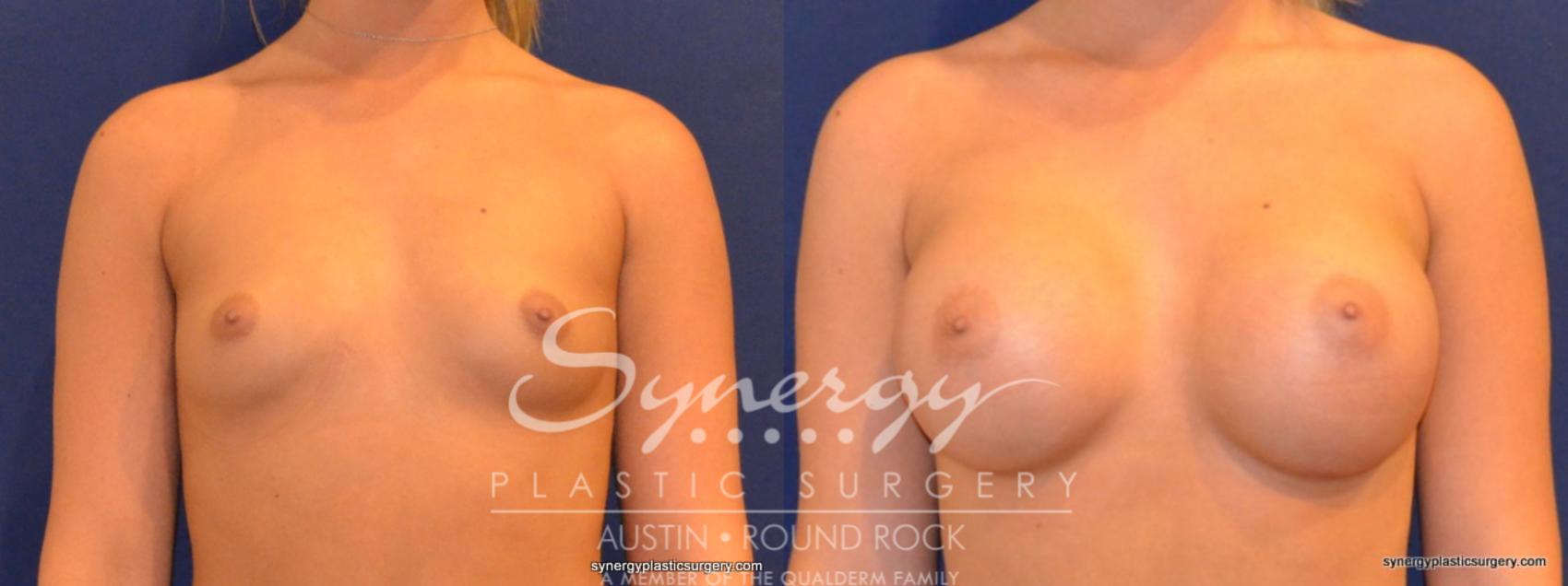 Before & After Breast Augmentation Case 265 View #1 View in Austin, TX