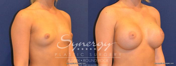 Before & After Breast Augmentation Case 265 View #3 View in Austin, TX