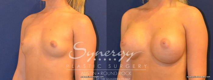 Before & After Breast Augmentation Case 265 View #4 View in Austin, TX