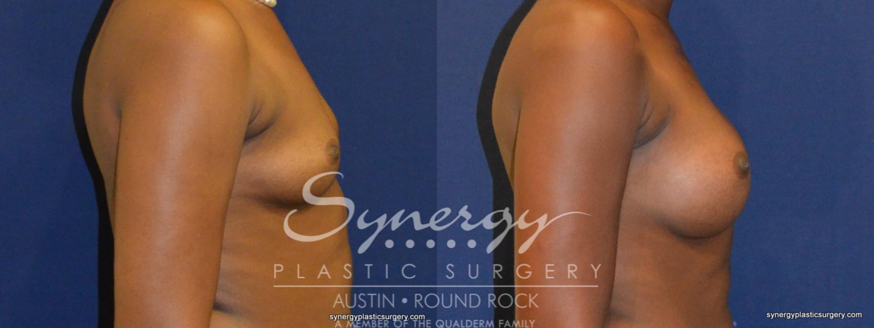 Before & After Breast Augmentation Case 267 View #1 View in Austin, TX