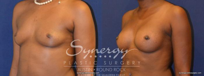 Before & After Breast Augmentation Case 267 View #2 View in Austin, TX