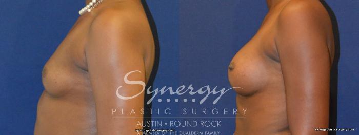 Before & After Breast Augmentation Case 267 View #3 View in Austin, TX