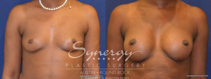 Before & After Breast Augmentation Case 267 View #4 View in Austin, TX