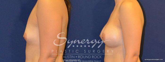 Before & After Breast Augmentation Case 269 View #1 View in Austin, TX
