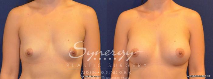 Before & After Breast Augmentation Case 269 View #2 View in Austin, TX