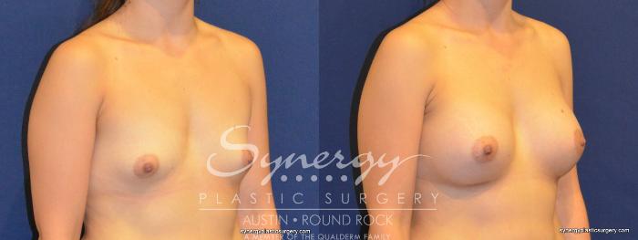 Before & After Breast Augmentation Case 269 View #3 View in Austin, TX