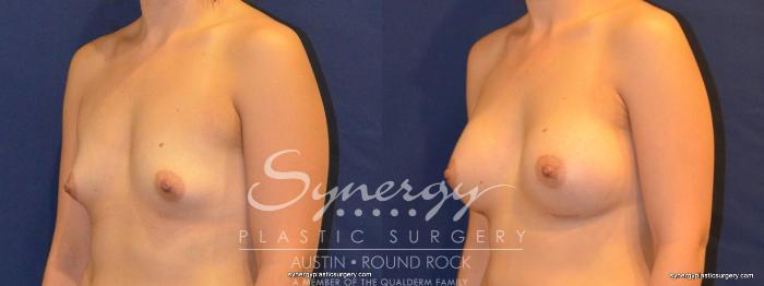 Before & After Breast Augmentation Case 269 View #4 View in Austin, TX