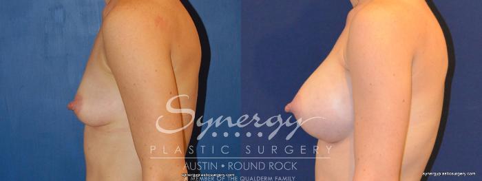 Before & After Breast Augmentation Case 270 View #1 View in Austin, TX
