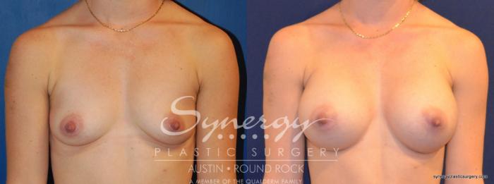 Before & After Breast Augmentation Case 270 View #2 View in Austin, TX