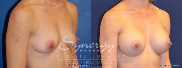 Before & After Breast Augmentation Case 270 View #3 View in Austin, TX