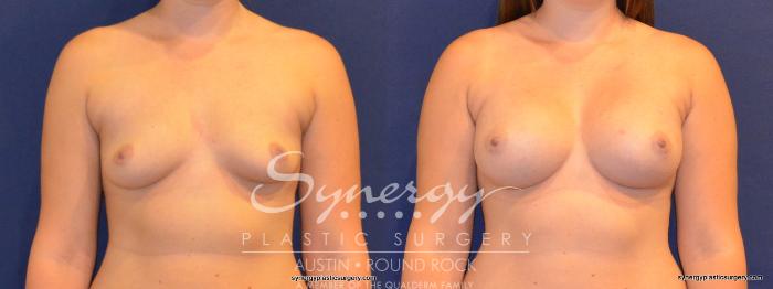Before & After Breast Augmentation Case 277 View #1 View in Austin, TX