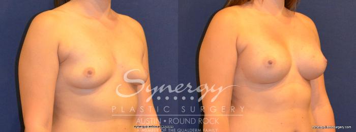 Before & After Breast Augmentation Case 277 View #2 View in Austin, TX