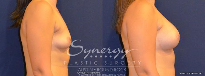 Before & After Breast Augmentation Case 277 View #3 View in Austin, TX