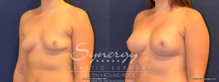 Before & After Breast Augmentation Case 277 View #4 View in Austin, TX