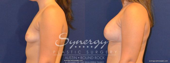Before & After Breast Augmentation Case 277 View #5 View in Austin, TX