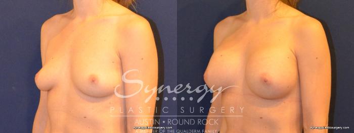 Before & After Breast Augmentation Case 281 View #1 View in Austin, TX