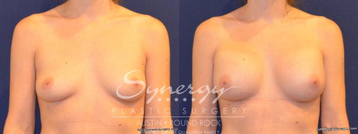 Before & After Breast Augmentation Case 281 View #2 View in Austin, TX