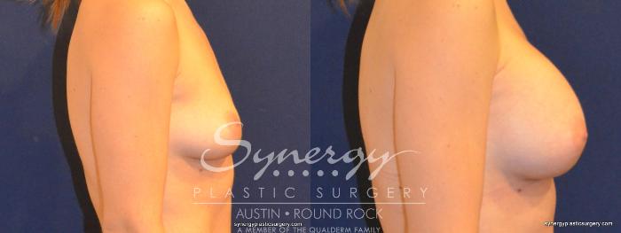 Before & After Breast Augmentation Case 281 View #3 View in Austin, TX