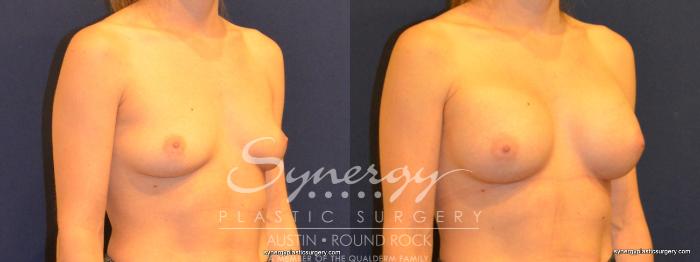 Before & After Breast Augmentation Case 281 View #4 View in Austin, TX