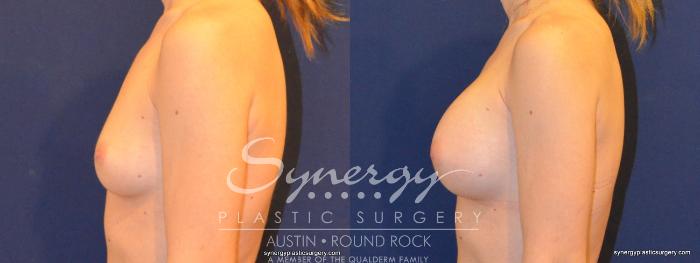 Before & After Breast Augmentation Case 281 View #5 View in Austin, TX