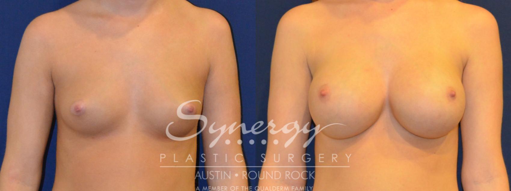 Before & After Breast Augmentation Case 285 View #1 View in Austin, TX