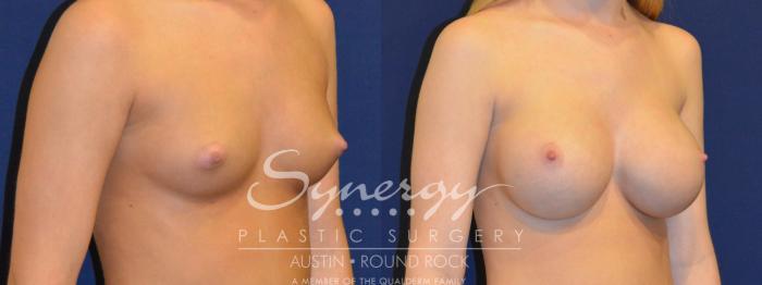 Before & After Breast Augmentation Case 285 View #2 View in Austin, TX