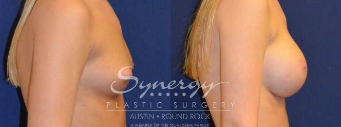 Before & After Breast Augmentation Case 285 View #3 View in Austin, TX