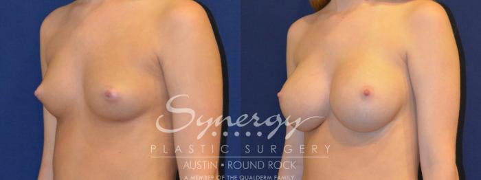 Before & After Breast Augmentation Case 285 View #4 View in Austin, TX