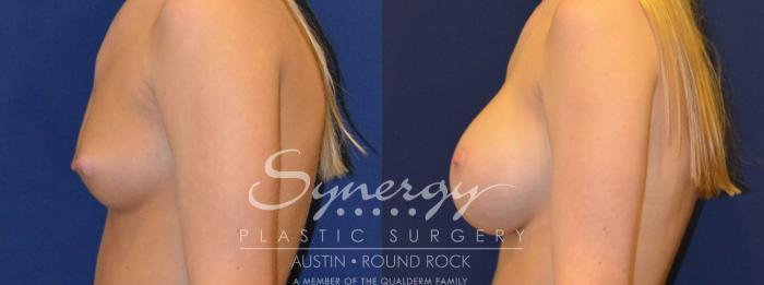 Before & After Breast Augmentation Case 285 View #5 View in Austin, TX