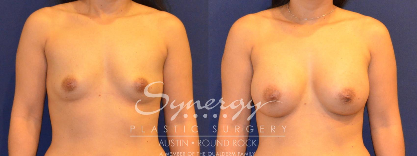 Before & After Breast Augmentation Case 293 View #1 View in Austin, TX