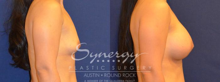 Before & After Breast Augmentation Case 293 View #2 View in Austin, TX
