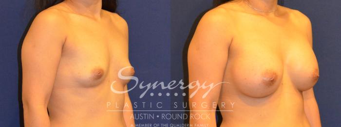 Before & After Breast Augmentation Case 293 View #3 View in Austin, TX