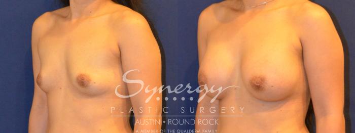 Before & After Breast Augmentation Case 293 View #4 View in Austin, TX
