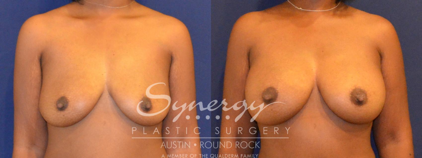 Before & After Breast Augmentation Case 298 View #1 View in Austin, TX