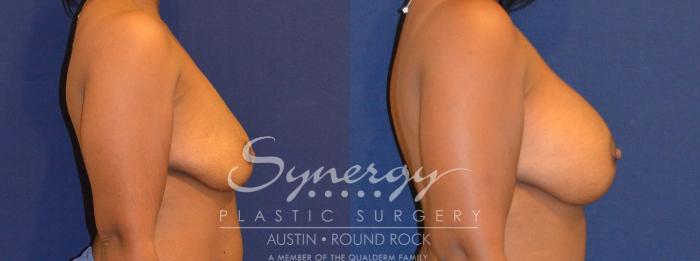 Before & After Breast Augmentation Case 298 View #2 View in Austin, TX