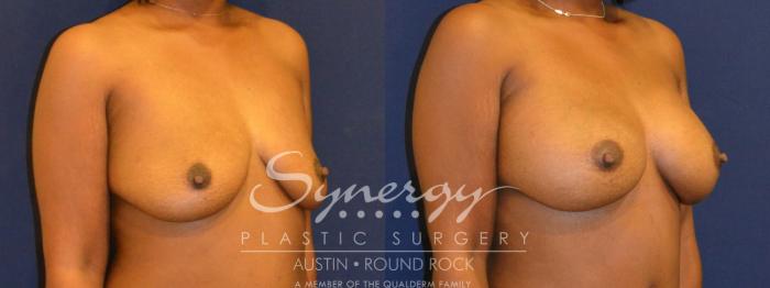Before & After Breast Augmentation Case 298 View #3 View in Austin, TX