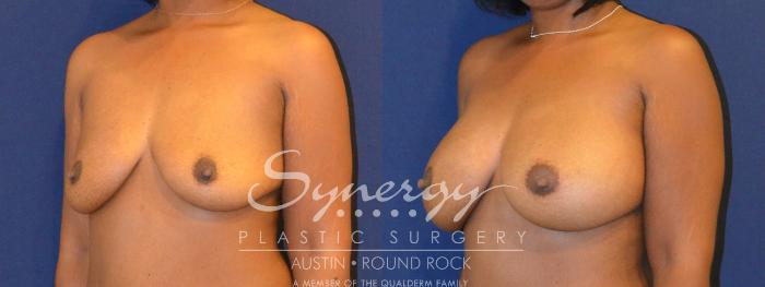 Before & After Breast Augmentation Case 298 View #5 View in Austin, TX