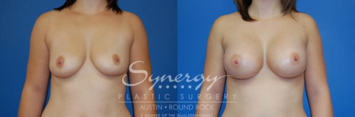 Before & After Breast Augmentation Case 3 View #1 View in Austin, TX
