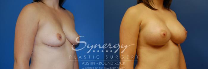 Before & After Breast Augmentation Case 3 View #2 View in Austin, TX