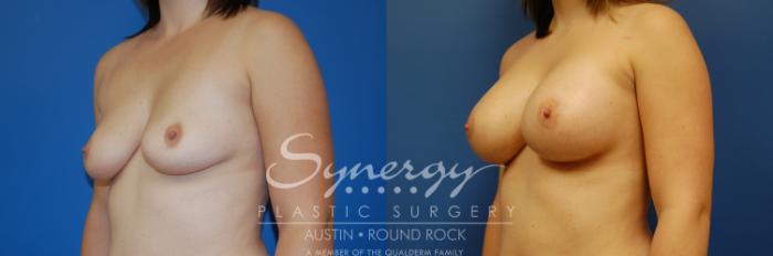 Before & After Breast Augmentation Case 3 View #3 View in Austin, TX